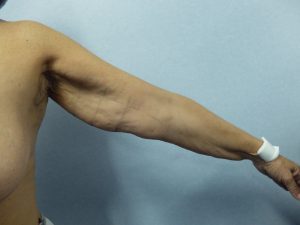 BRAQUIOPLASTIA | Cirugía de los brazos